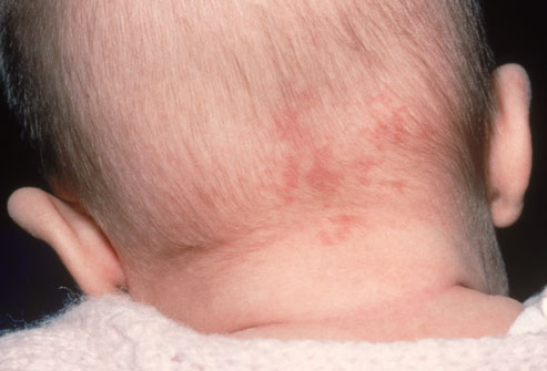 Some fade as baby grows, but patches on the back of the neck usually don't 