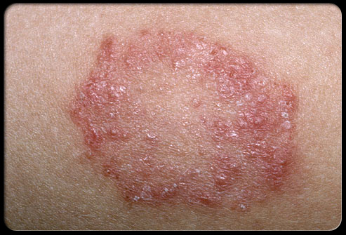 treatment for ringworm. Home treatment of ringworm