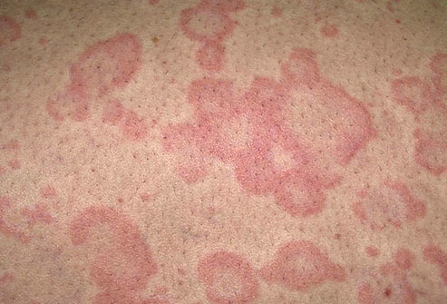 allergic reaction rash. A non-contagious rash of thick