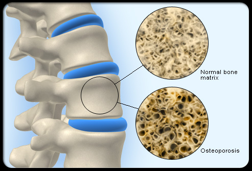 osteoporosis1 Osteoporosis y ejercicio fisico