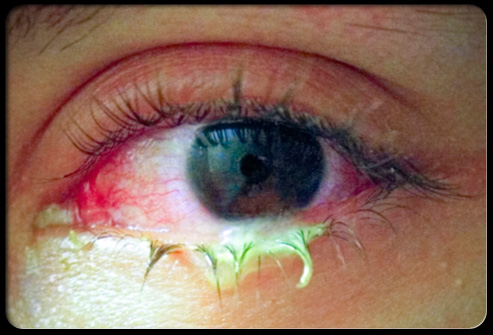 Pink eye, or conjunctivitis, is redness and inflammation of the membranes 