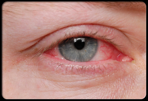 Eye Allergies. Severe allergic eye symptoms can be very distressing and are 