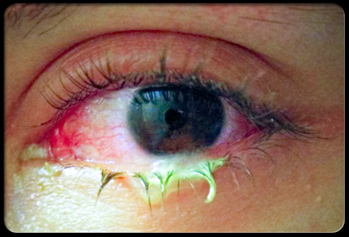 Allergic Pink Eye Pictures. Also known as pinkeye,